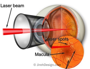 http://jirehdesign.com/images/tmc_eye_illustrations/DiabeticRetinopathyLaser.jpg